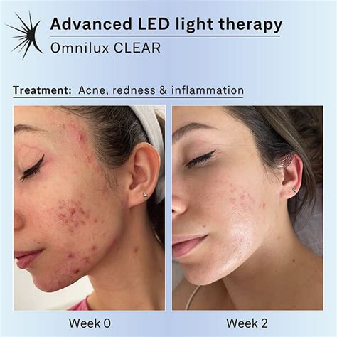 Do Led Light Therapy Masks Really Work Dermacare Direct