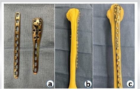 A B C Implants Utilized Synthes 3 5 Mm LCP Proximal Humerus Plate