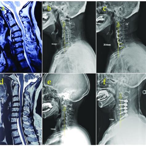 A Preoperative MRI Showing Cervical Spinal Stenosis And Myelopathy