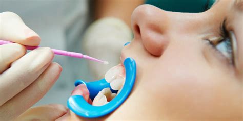 Mouthguard Dentist Kent WA Seablue Dental