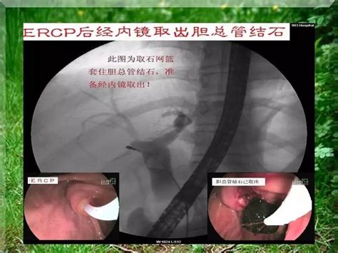 Ercp胆总管取石术图解 千图网