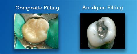 Dental Filling Showdown Amalgam Vs Composite Carifree