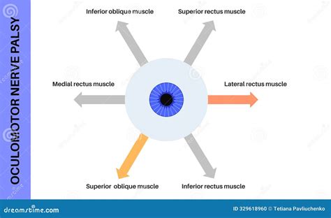 Oculomotor Nerve Palsy Vector Illustration CartoonDealer 331702146