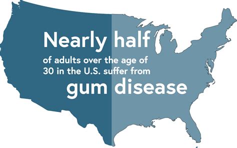 Gum Disease St Louis Mo Periodontal Treatment Justin M Schlaikjer