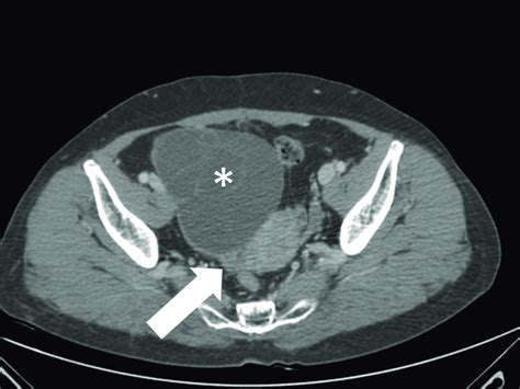 A 58 Year Old Woman With Right Ovarian Mucinous Cystadenoma Axial