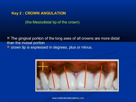 Andrews Six Keys Of Occlusion Certified Fixed Orthodontics Courses