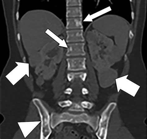 Comprehensive Imaging Manifestations Of Tuberous Sclerosis Ajr