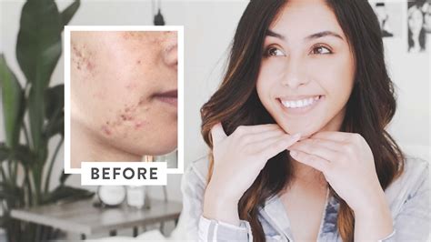 How I Cleared My Acne Skincare Routine Youtube