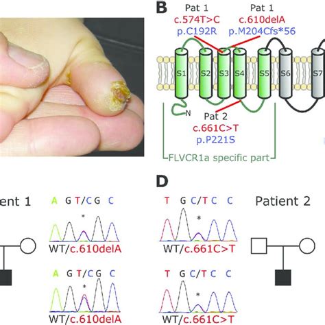 Flvcr Mutations Impair Heme Export In Patient Derived Cells A