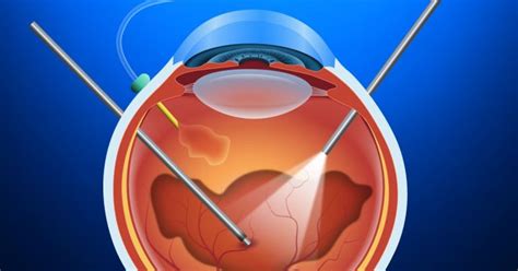 Vitrectomy | Indications | Procedure | Cost - Sutured