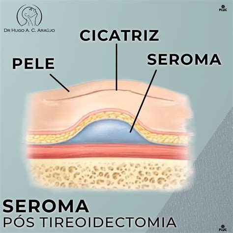 O Que É Seroma Na Cirurgia - Seroma Pós Tireoidectomia