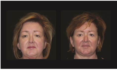 Atlanta Facelift Surgery | Before and After Photos