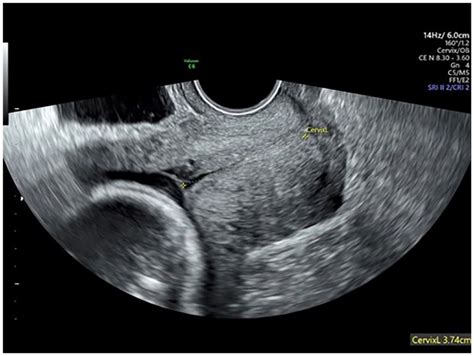 Comparison Of Transabdominal And Transvaginal Sonograms In Evaluation