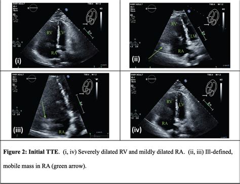 Management Of Right Atrial Clot In Transit And Acute Pulmonary Emboli