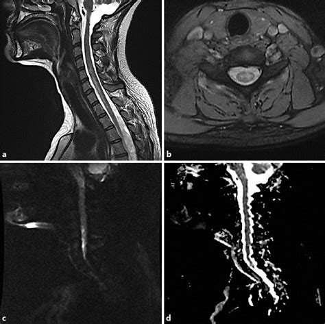 A T2 Weighted Sagittal MRI Of The Cervical Spine B T2 Weighted Axial