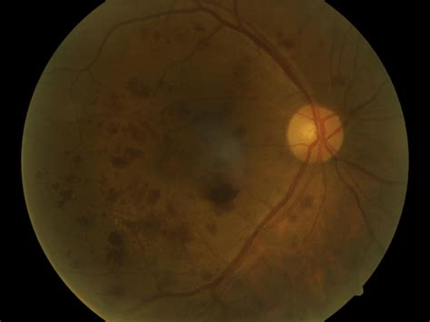 Retinal Fundus Images With Different Stages Of Dr A No Dr B Mild Download Scientific