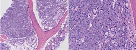 Aggressive Plasmablastic Myeloma With Extramedullary Cord Compression