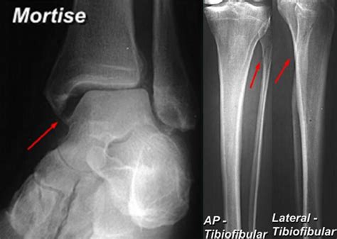 High Ankle Sprain Syndesmosis Injury Foot Ankle Orthobullets