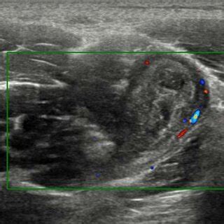 Longitudinal Ultrasonography With Colour Doppler Of The Upper Right