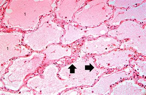 Pulmonary Edema Pathology