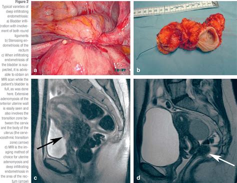 Figure 2 From The Diagnosis And Treatment Of Deep Infiltrating