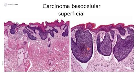 Carcinoma Basocelular Youtube