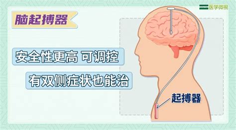 帕金森不止手抖这么简单！早期这些症状，千万别忽视！澎湃号·政务澎湃新闻 The Paper