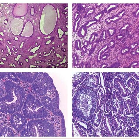 Immunohistochemical Findings In Atypical Endometrial Hyperplasia A Download Scientific