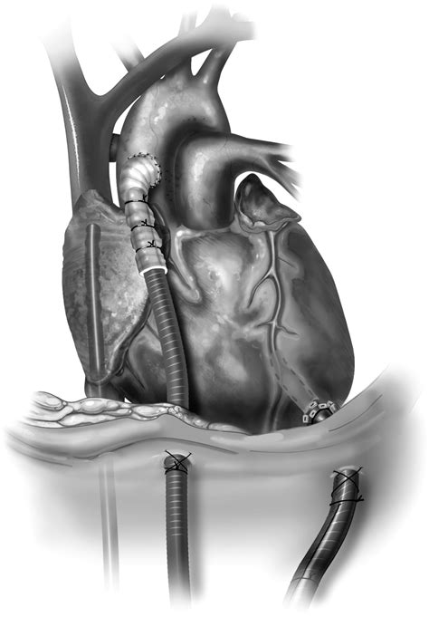 Techniques For Venoarterial Extracorporeal Membrane Oxygenation Support