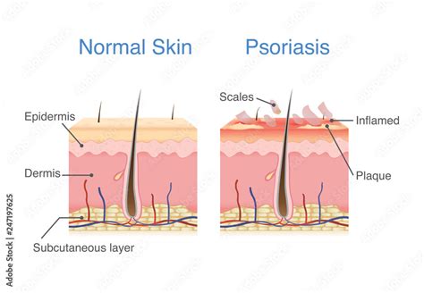 Normal skin layer and skin when plaque psoriasis signs and symptoms ...