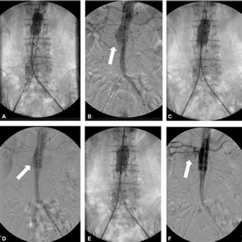 Type 1b Endoleak From Distal Of The Aortic Extension Graft To The