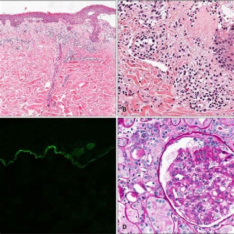 A B Subepidermal Bulla With Mixed Inflammatory Infiltration In The Download Scientific