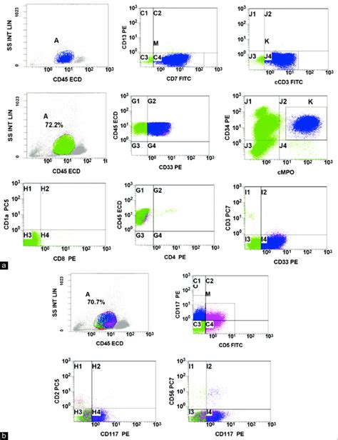 A ETP Phenotype With Subset Of CD34 Positive Blasts Expressing