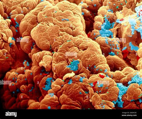 Colon Cancer Coloured Scanning Electron Micro Graph SEM Of The