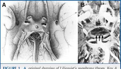 Figure 1 From MICROSURGICAL AND ENDOSCOPIC ANATOMY OF LILIEQUIST S