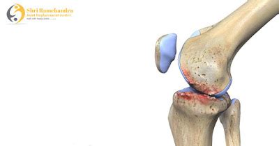 What Is Crepitus? Common causes of creptius; Crepitus May Be Early ...