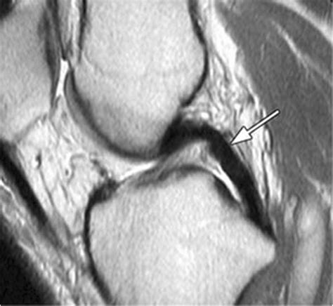 Intact PCL on sagittal MRI T1 sequence | Download Scientific Diagram