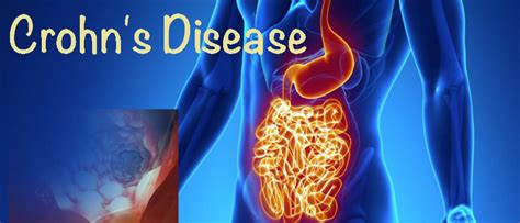 Crohn's Disease | Symptoms | Causes | Treatment | Natural Remedies