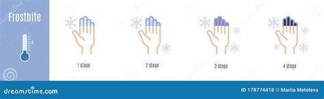 Stages Of Hand And Fingers Frostbite Hypothermia Stock Vector