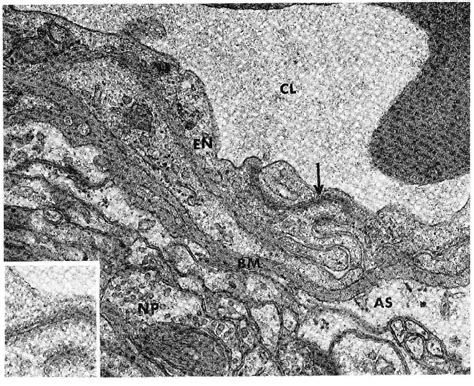 Hypertensive Encephalopathy | Semantic Scholar