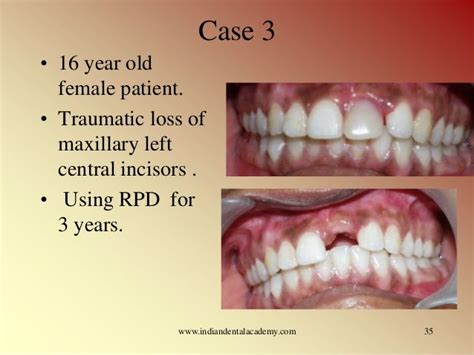 Resin Bonded Bridges Modi Certified Fixed Orthodontic Courses By Ind