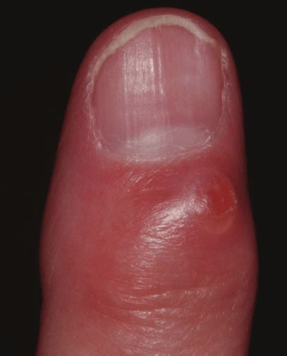 2 Type A Myxoid Cyst Located On The Dorsum Of The Digit Download