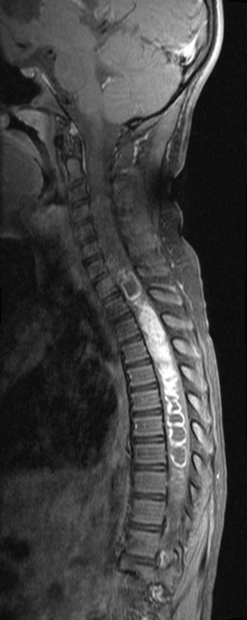 Spinal Cord Astrocytoma Image Radiopaedia Org