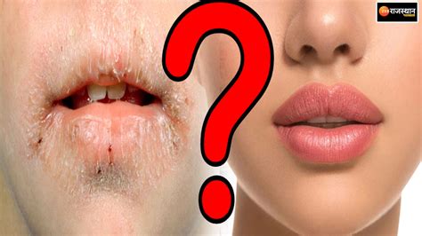 Infection On Lips In Hindi Lipstutorial Org