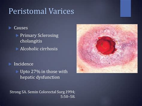 Stoma complications & its management