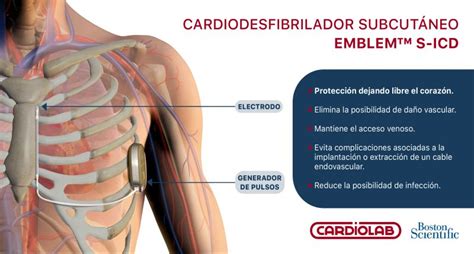 Cardiodesfibrilador subcutáneo todo lo que hay que saber Cardiolab