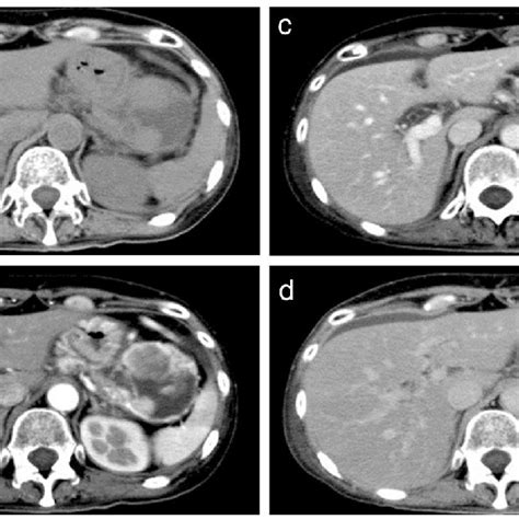 Dynamic Contrast Enhanced Computed Tomography Ct Findings A Plain Ct