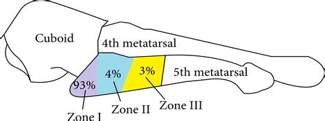 metatarsal fractures  repair  rehab physio network