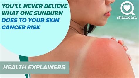 You Ll Never Believe What One Sunburn Does To Your Skin Cancer Risk Health Explainers