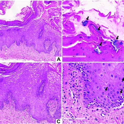 Histopathological Aspects Of Case 1 Stratified Squamous Epithelium